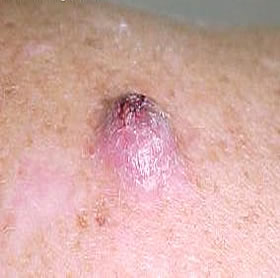 Foto-carcinoma-epidermóide6